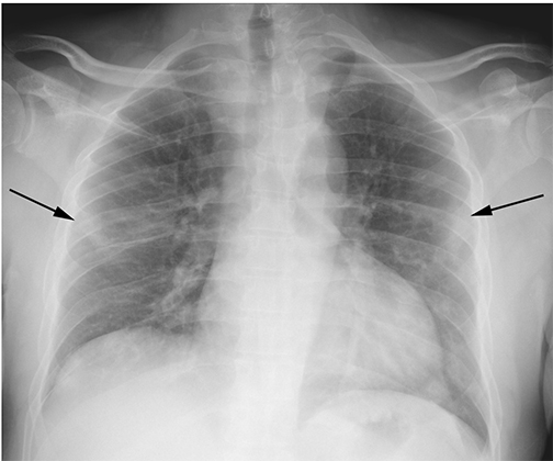 chesy x-ray suggesting COVID